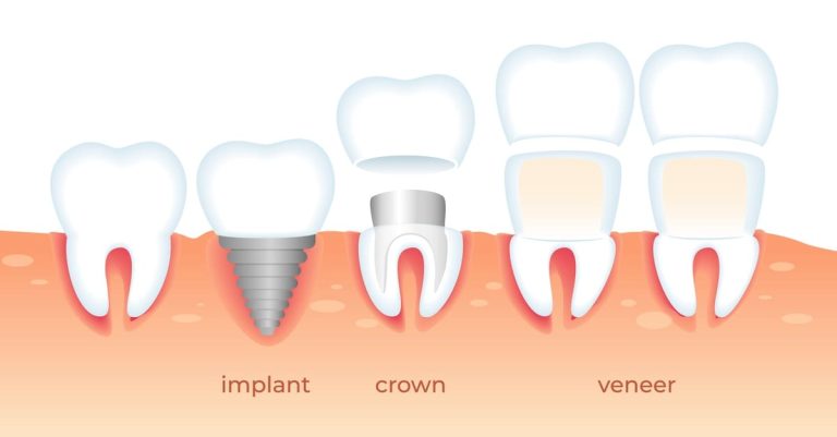 Dental Veneers vs. Crowns