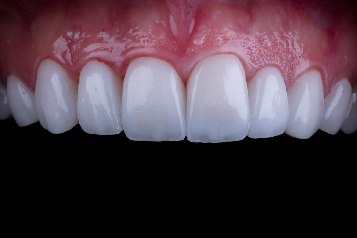 Can Veneers Damage Your Real Teeth? 