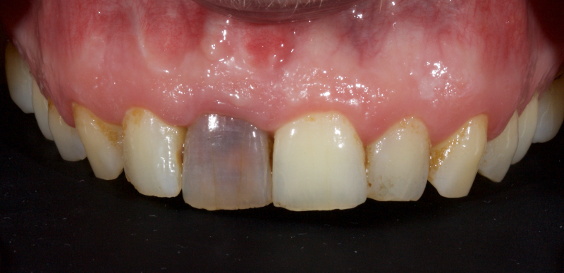 Tooth Discoloration