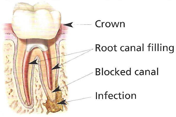Root Canal vs Filling: Which One Is Right for Your Tooth?