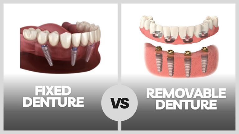 Fixed vs. Removable Dental Implant